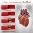 thumbnail image 3 of Modelo de aterosclerosis humana, enfermedad arterial vascular en cuatro etapas, 2 unidades., 3 of 5