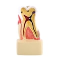 thumbnail image 1 of Modelo de diente, 1 pieza Modelo de caries patológica integral dental Modelo de educación dental Parte superior de la línea, 1 of 8