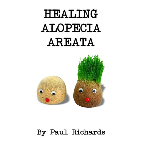 Healing Alopecia Areata - eBook (Best Ayurvedic Medicine For Alopecia Areata)