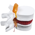 thumbnail image 2 of 2X Human Anatomy Skeleton Spine Lumbar Disc Herniation Teaching Model Brain Traumatic School Supplies Instrume, 2 of 9