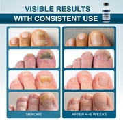 FUNGINIX Toenail Fungus Treatment Extra Strength - Antifungal Nail Treatment With 10% Undecylenic Acid & Tea Tree Oil - Includes Natural Oils & Botanicals - Made in USA (Packaging Does Vary)