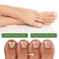 thumbnail image 4 of 10ML Health Toenail Stick Roller Bead Onychomycosis Care Solution for Women Men, 4 of 5