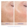 thumbnail image 4 of Peel System es CLINICAL Active para la exfoliación facial, 4 of 6