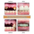 thumbnail image 4 of 26-27 2024 Nwe Diy Denture Kit, Denture Diy Kit Is Simple And Convenient Diy Denture Repair Missing, Sn (319), 4 of 5