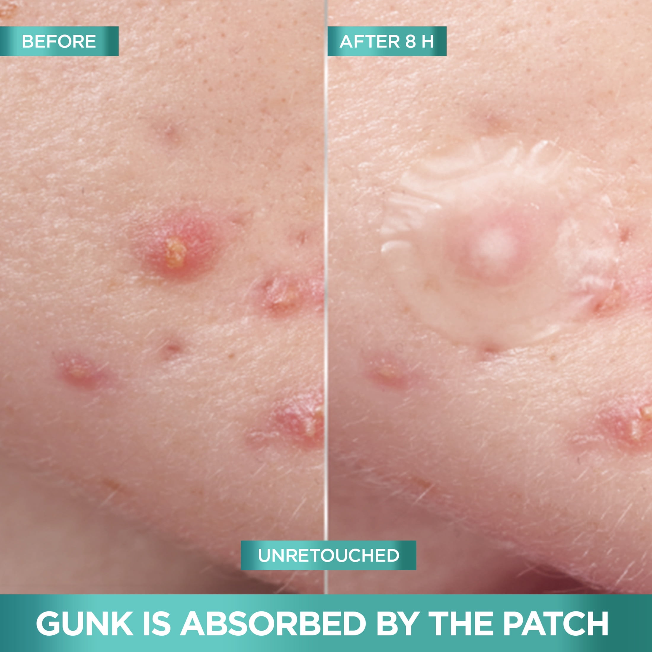 Garnier Imperfection Patch, Invisible Hydrocolloid Patches, 44 Count