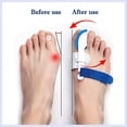 thumbnail image 4 of 2pcs Bunion Corrector, Night Bunion Splints And Bunion Relief Adjustable Bunion Valgus Splint Protector, 4 of 5