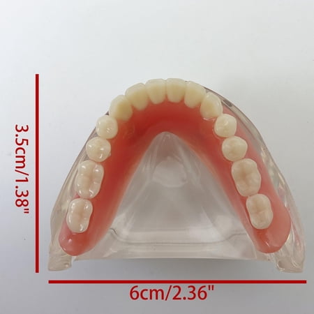 Dental Model Overdenture Inferior 2 Implants Demo for Studing and Teaching