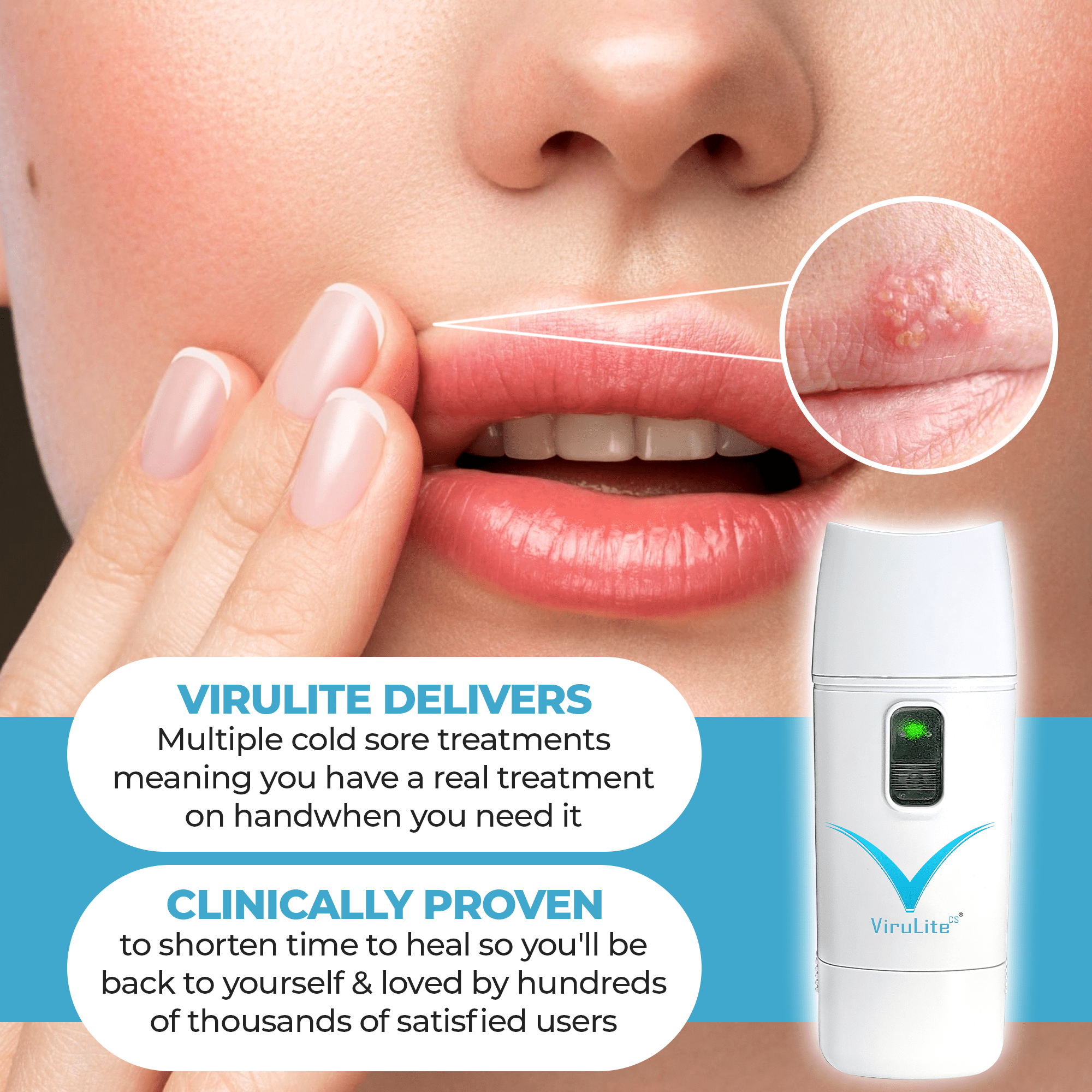 ViruLite Cold Sore Light Therapy Device – Clinically Proven Red Light Treatment for Cold Sores and Fever Blisters – Drug-Free, Portable, Fast Relief