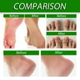 thumbnail image 3 of Clearance & Promo, Exfoliating Foot Spray for Softened Skin and Keratin RemovalHydrating and Softening, 20ml for Smoother Feet, Daily Foot Care Solution, Ideal for Callus Reduction | Plastic, B, 3 of 7