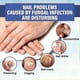thumbnail image 3 of 3pcs Nail Fungus Laser Treatment Device For Nails With Mushrooms Repair Toenail Fingernail Fungus Treat Onychomycosis In, 3 of 5