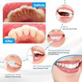 thumbnail image 5 of Irrigador dental sónico eléctrico YONGSHENG escalador eliminador de cálculo dental Limpiador blanqueador de dientes, 5 of 5
