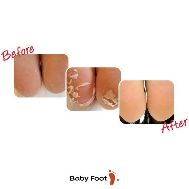 Best baby foot peel walmart in store Cheap Sale Baby foot peel walmart in store online