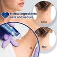 thumbnail image 5 of Wartsoff Crema para eliminar imperfecciones instantáneas, crema para eliminar verrugas, ungüento para eliminar verrugas para todo tipo de piel, 5 of 5