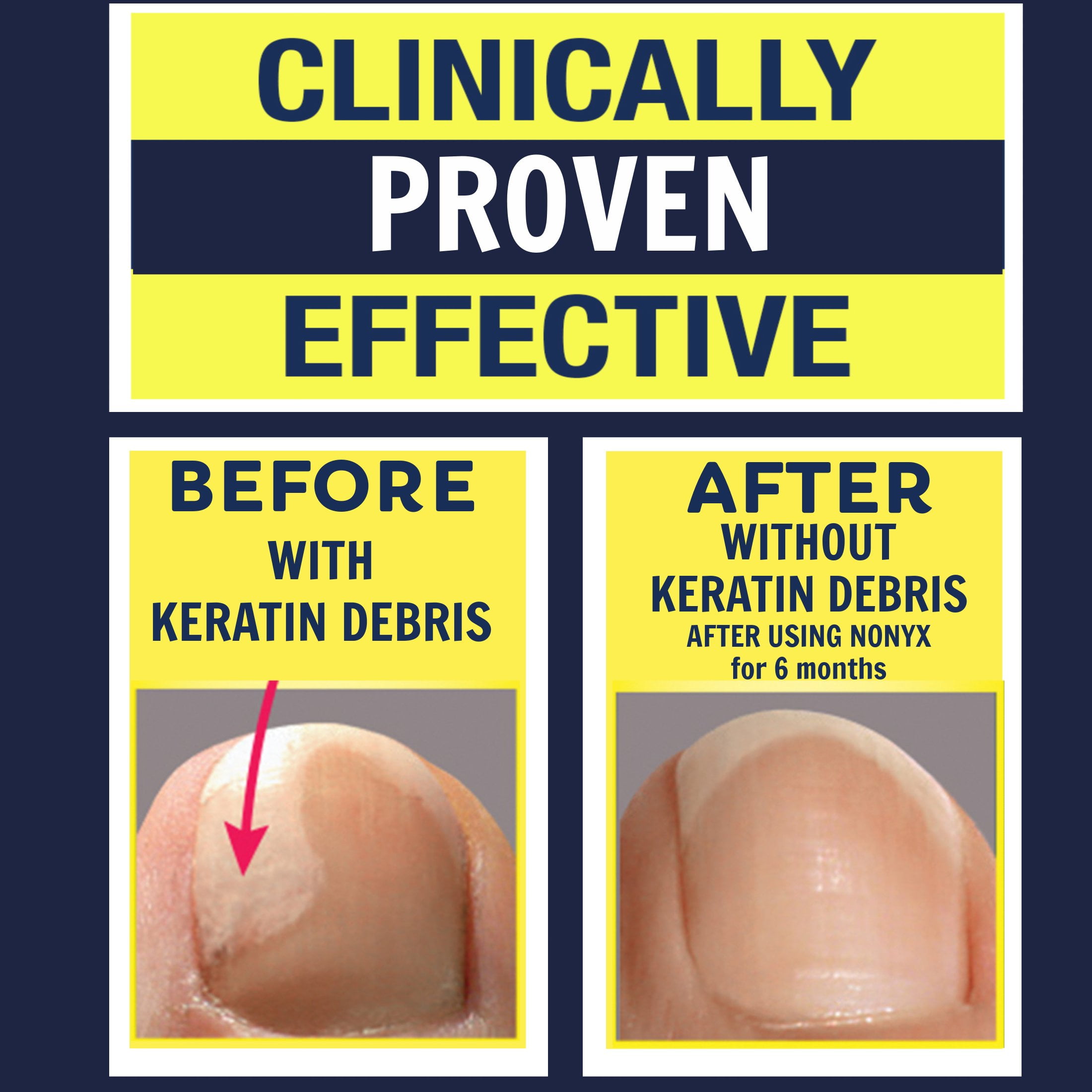 NonyX Fungal Nail Clarifying Gel, 4 oz