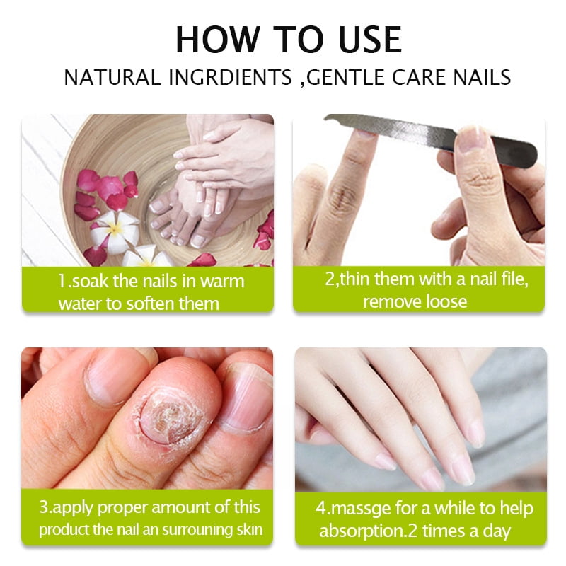 Suffer From Brittle Nails? Returning Your Nails To Health | Nail Repair Gel  Toenail Fungus Treatment Gel Restore Brittle Yellow Nails For Damaged Nails  