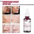 thumbnail image 2 of Salicylic Acid Facial Peel, 2 of 5