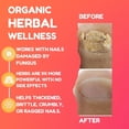 thumbnail image 5 of Dermveda Nail Serum Restoring Solution for Toe Nail Fungus Damage, 4 Fl Oz, 5 of 5