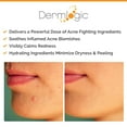 This Natural Remedy Clears Big Blackheads Like Magic - ogmlzjq