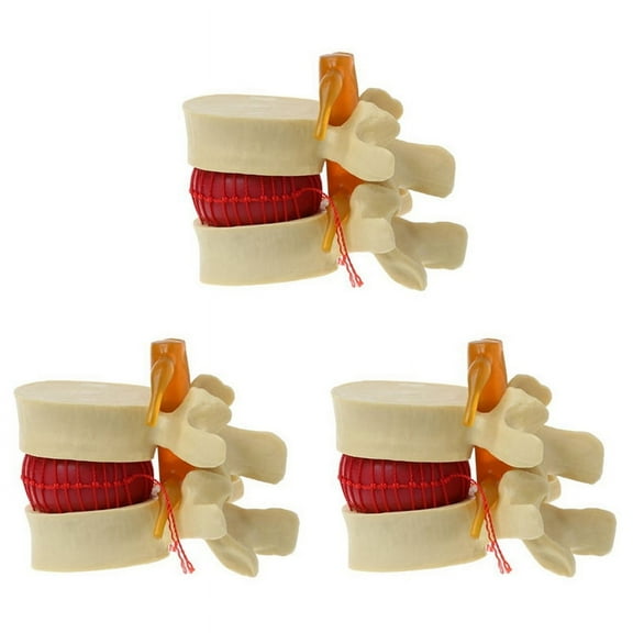 3X Lumbar Vertebrae Model Anatomical Spine Lumbar Disc Herniation Anatomy Teaching Tool Lumbar Vertebrae Model