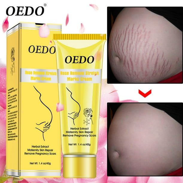 cara menggunakan oedo rose remove stretch mark cream