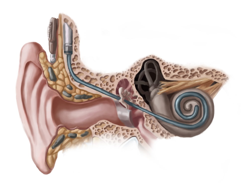 Cochlear Implant, Illustration Poster Print by Spencer Sutton/Science ...