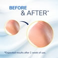 thumbnail image 5 of Dr. Scholl's Cracked Heel Repair Balm (2.5oz) 25% Urea. Heals and Moisturizes feet, 5 of 20