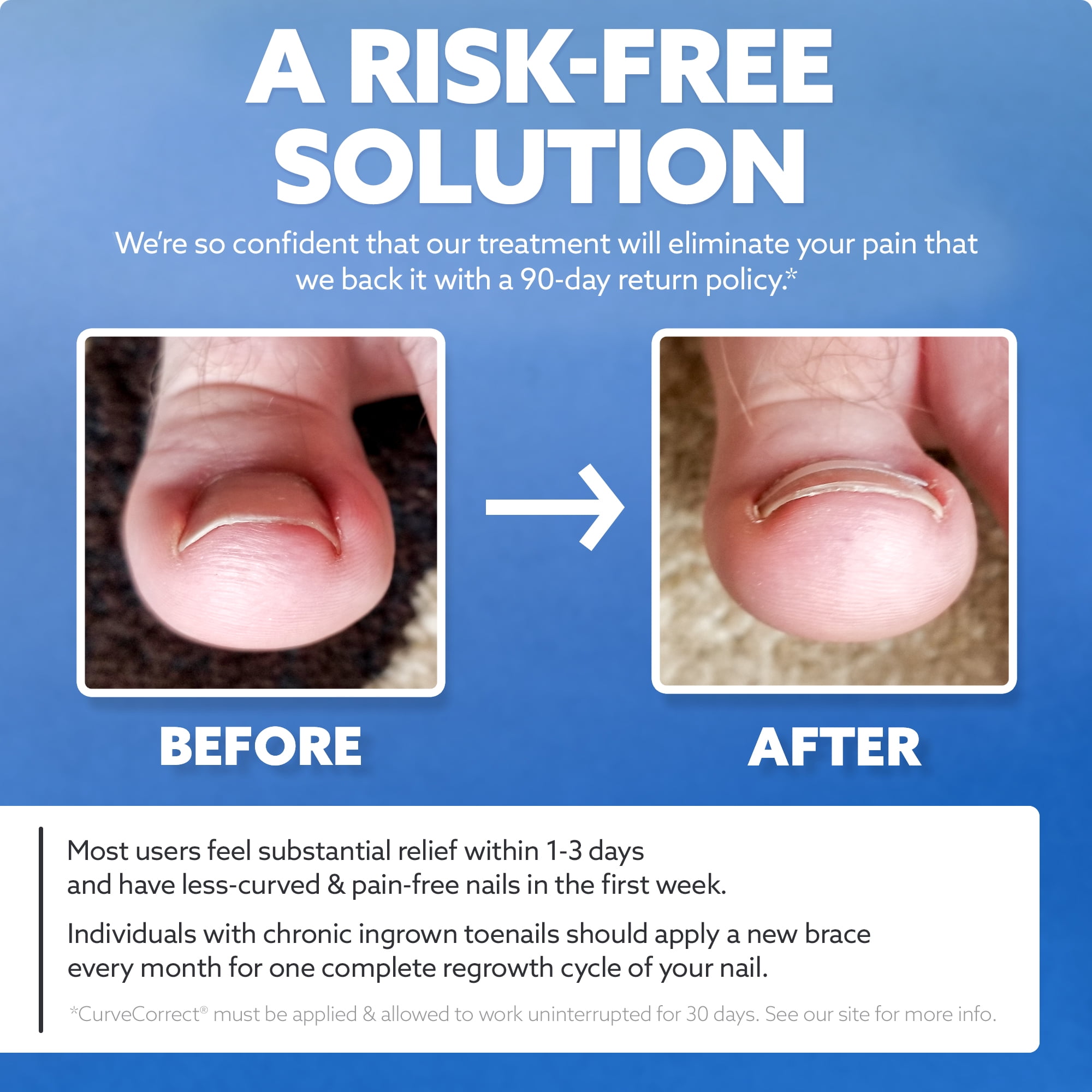 CurveCorrect® Ingrown Toenail Corrector Kit - 10 Braces for In Grown Toe Nail Treatment