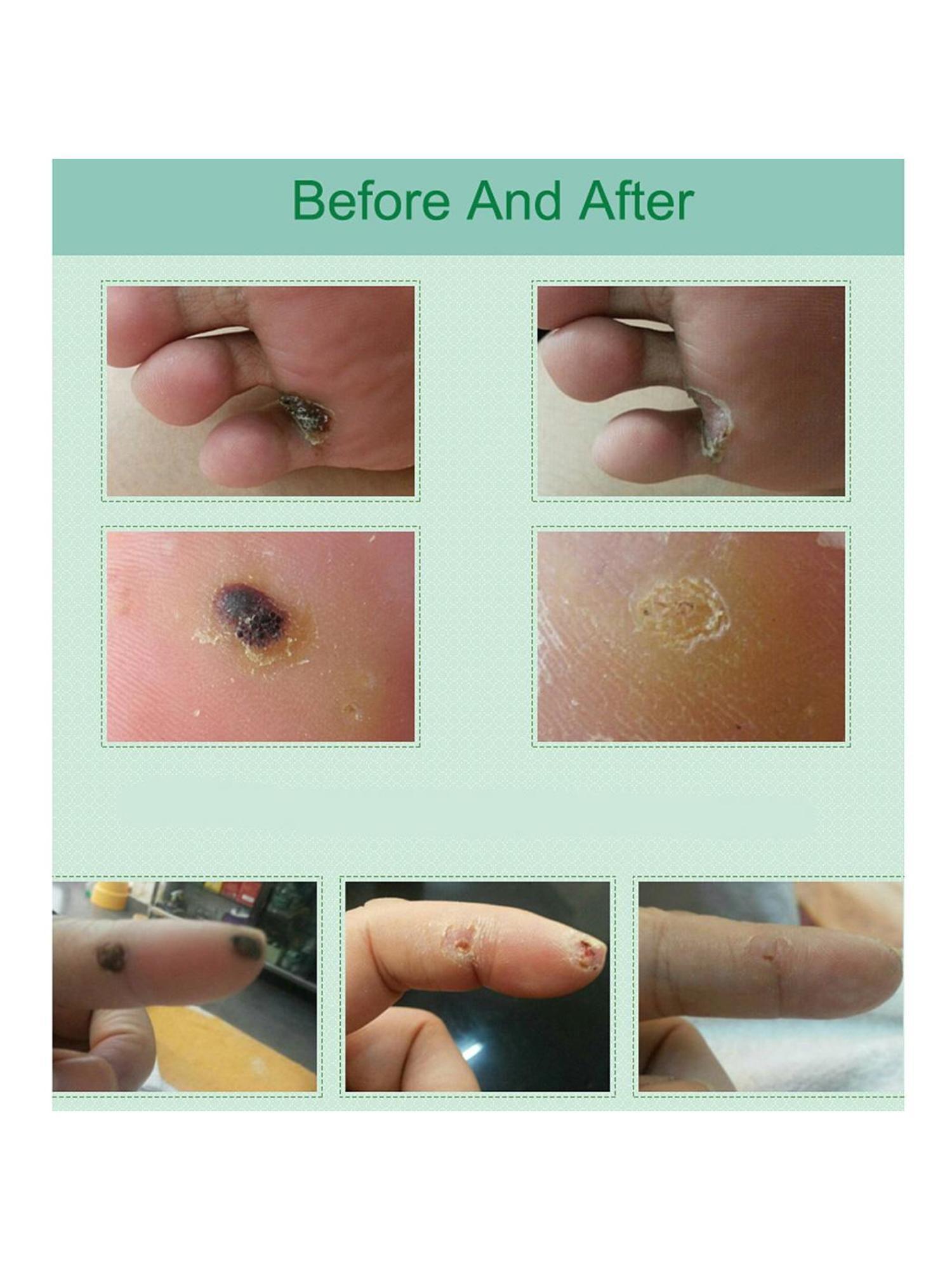 foot corn removal plaster