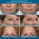 thumbnail image 5 of Sérum para ojos Plexaderm Rapid Reduction Advanced 9 ml x30, 5 of 8
