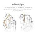 thumbnail image 4 of 1 par 2 uds separador de dedos de los pies hueso pulgar ortopédico Hallux Valgus Corrector (B), 4 of 5