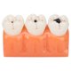 thumbnail image 5 of Modelo de caries dental, Caries dental de resina Modelo de caries de dientes Tiempos Modelo de caries Características líderes en su clase, 5 of 5