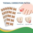 thumbnail image 3 of 100Pcs Ingrown Toenail Correction Stickers Nail Corrector Patches Nail Care Tools, 3 of 12