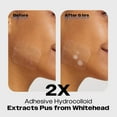 AVARELLE Pimple Patches for Face ZITOUT™ Acne Patches Pimple