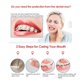 thumbnail image 2 of Alivio del dolor de cera dental para usuarios de aparatos de ortodoncia 1 caja TFixol Marrón y 500ml, 2 of 7