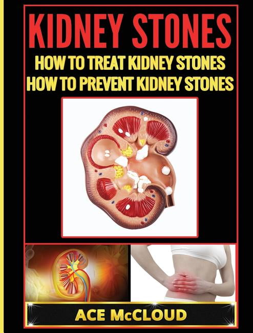 ivcd 10 for hx of kidney stones ivcd 10 for hx of kidney stones