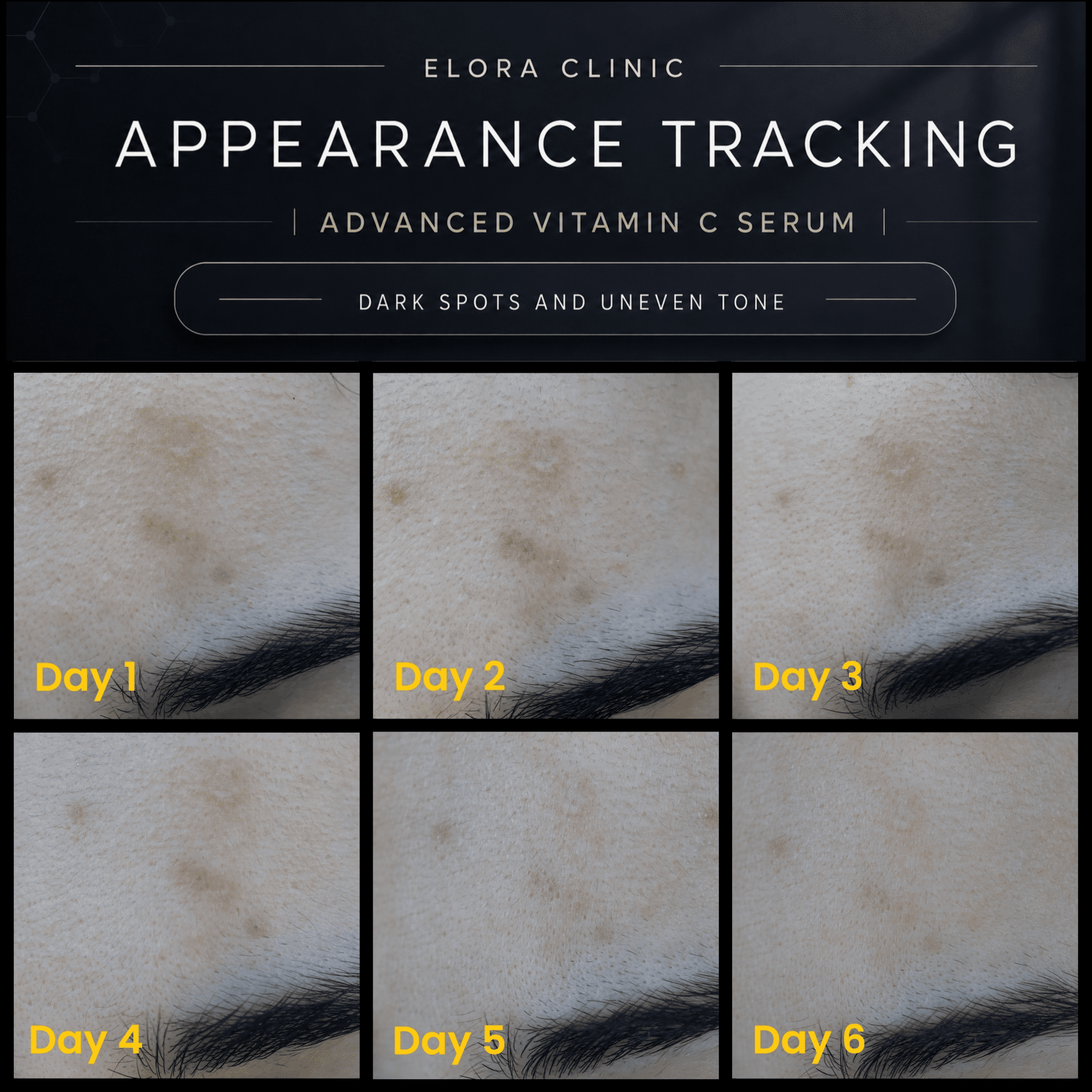 Elora Clinic Vitamin C Serum with Hyaluronic Acid– brightening and pore minimizer – Advanced Vitamin c with glow and hydration
