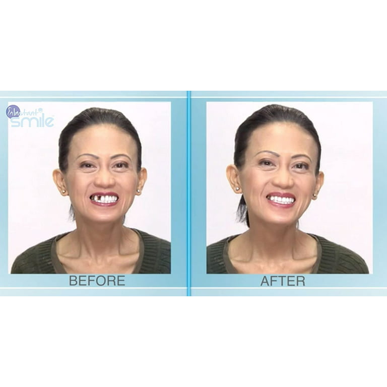 $4/mo - Finance Teeth Repair Kit, Temporary Teeth replacement kit