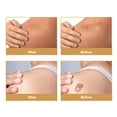 thumbnail image 4 of Silicone Scar Tape, Breathable Trimmable Scar Sheets  Gentle  For Full Body, 4 of 8