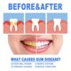 thumbnail image 3 of Gum Repair Gel Rebuilding Strengthen Whiten Remove Breath Inflammation Oral Tooth Bad Protect Anti Gingival Stains, 3 of 5