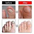 thumbnail image 2 of Nail Sticker Toenail Correction Nail Groove Inlay Nail Co, 2 of 5