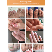 LANBENA Nail Repair Essence Serum Remove Onychomycosis Fungal Nail Treatment USA