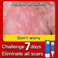 thumbnail image 5 of Crema para eliminar cicatrices, Gel para eliminar manchas de acné, tratamiento de estrías, quemadura, cirugía, crema reparadora de cicatrices, alisado, blanqueamiento, belleza de la piel, 5 of 5