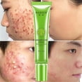 thumbnail image 1 of Crema eficaz para eliminar el acné, tratamiento para el cuidado de manchas de cicatrices de acné, Control de aceite, reducción de poros, blanqueamiento, Gel hidratante antiacné para la cara Feliz Sencillez, 1 of 5