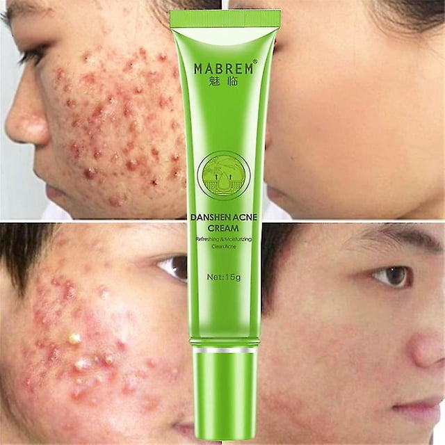 Crema eficaz para eliminar el acné, tratamiento para el cuidado de manchas de cicatrices de acné, Control de aceite, reducción de poros, blanqueamiento, Gel hidratante antiacné para la cara Feliz Sencillez