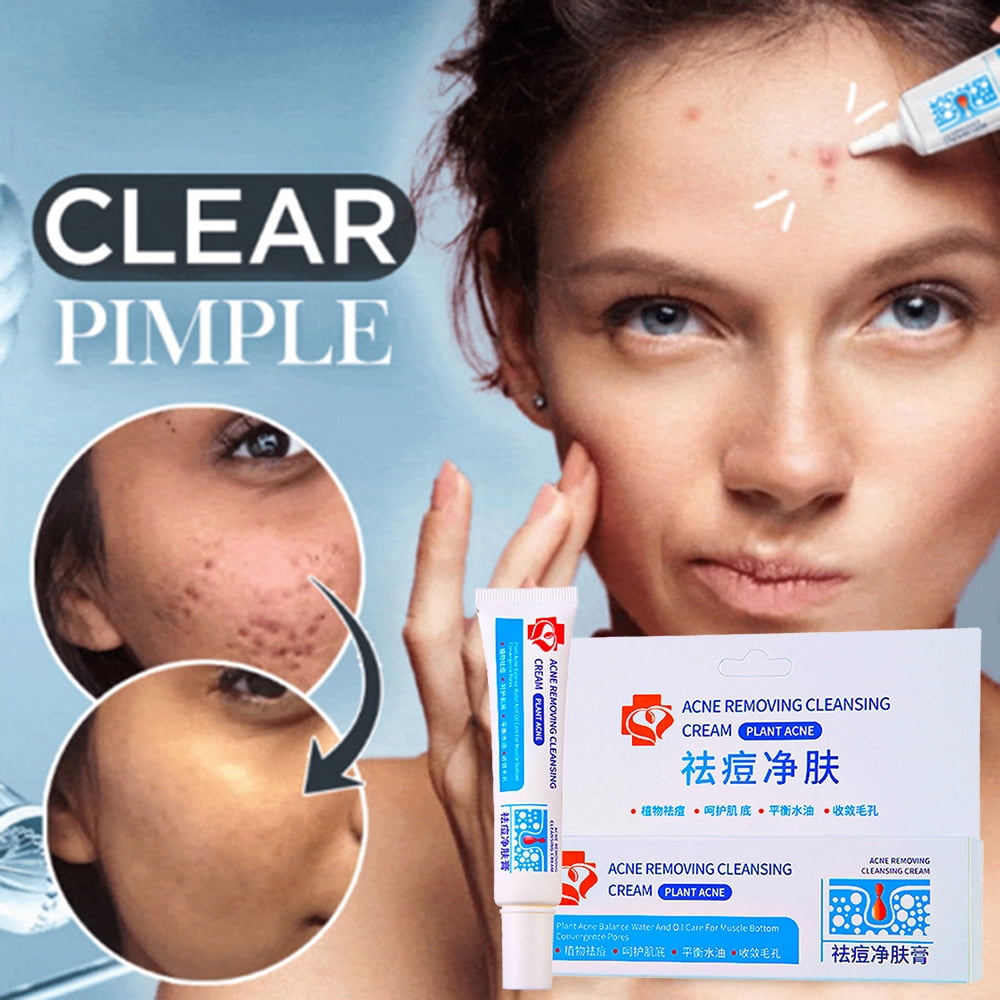 Blemish Removal Cream AntiAcne Pimples Nature Herb Safe Acne Removal Cream New TOPOINT