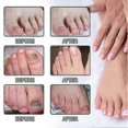 thumbnail image 5 of Essential Oil Nail Fungus Repair Liquid Nail Thickening Discoloration Off Soft Nail Thickening Type Onychomyc 20m, 5 of 5