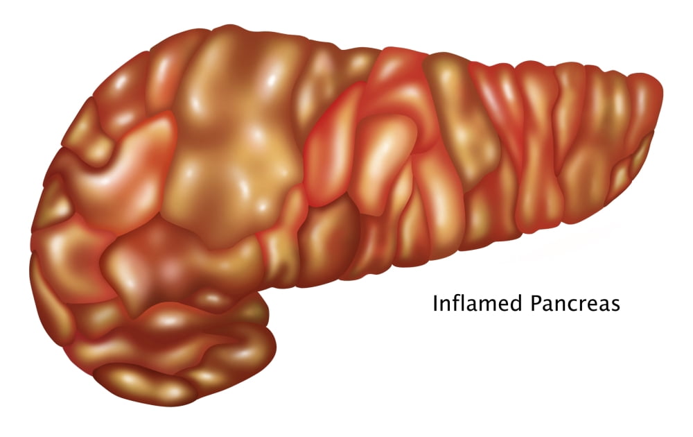 Inflamed Pancreas Illustration Poster Print by Gwen ShockeyScience