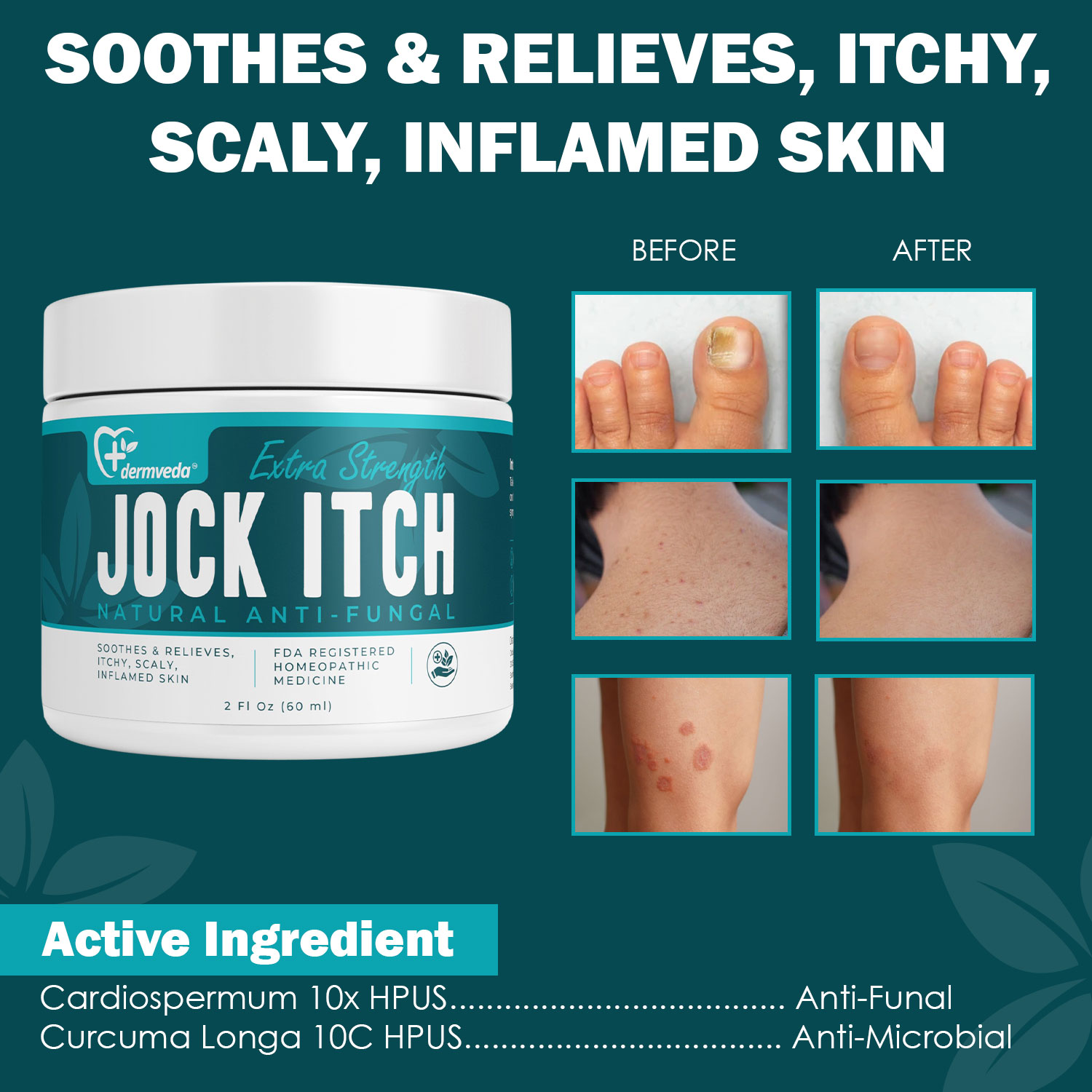 Dermveda Jock Itch Cream Extra Strength Treatment For Men And Women Fungal Cream For Skin