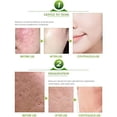 thumbnail image 5 of AICHUN BEAUTY Face Acne Cleaning Cream Skin Care Remove Repair Comedone Pimple Acne Face Acne Cream, 5 of 9