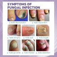 thumbnail image 2 of 2 piezas Medinail Spray para hongos Nuevo, 2 of 5